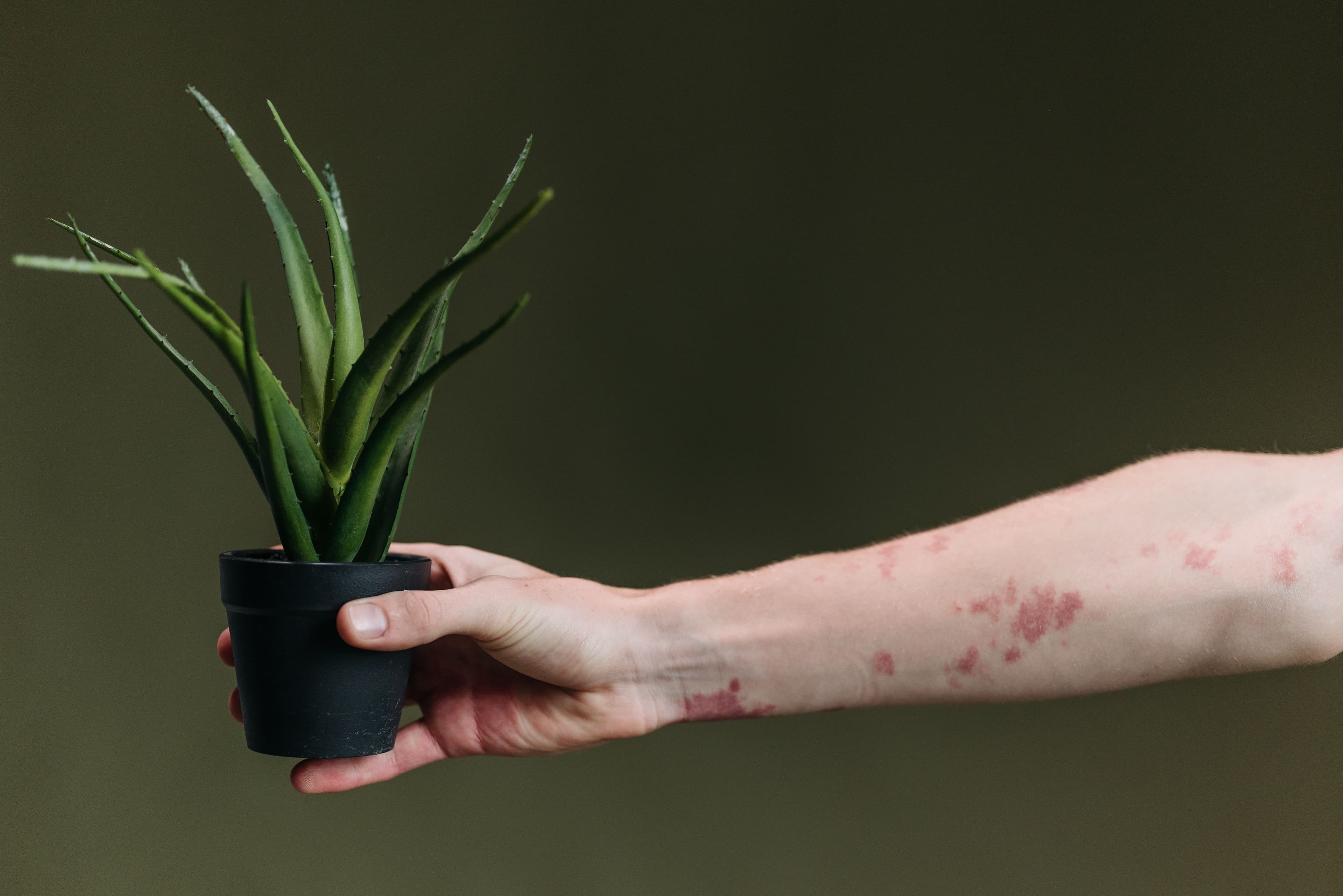 Arm with a red, patchy skin rash holding a small potted aloe plant